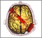 Traumatic Brain Injury