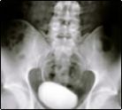 Traumatic Spinal Cord Injury Attorneys Traumatic Spinal Cord Injury Attorneys
